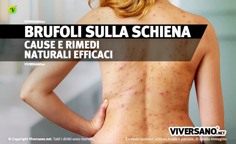 Brufoli sulla schiena: rimedi naturali per eliminarli