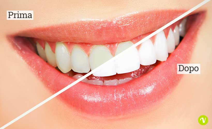 Come sbiancare i denti