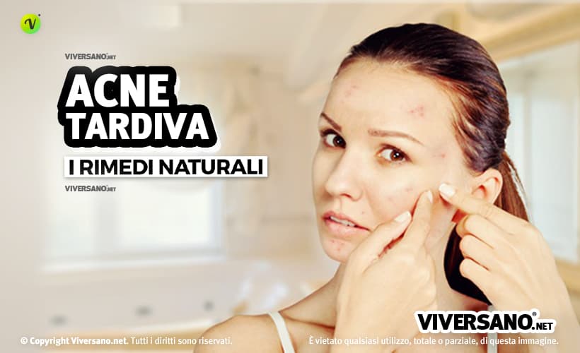 Immagine di donna con acne tardiva
