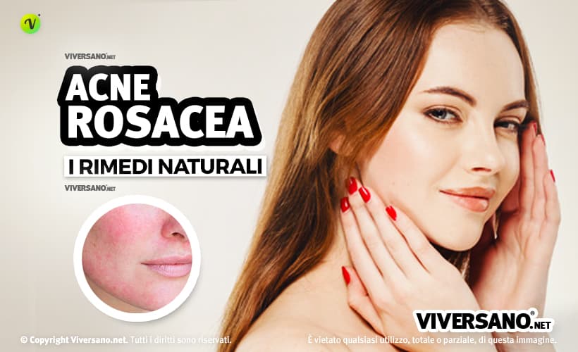 Donna con acne rosacea sul viso
