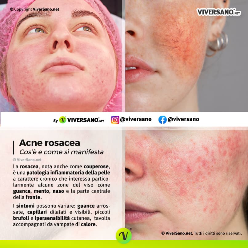 Immagine che rappresenta i sintomi della rosacea