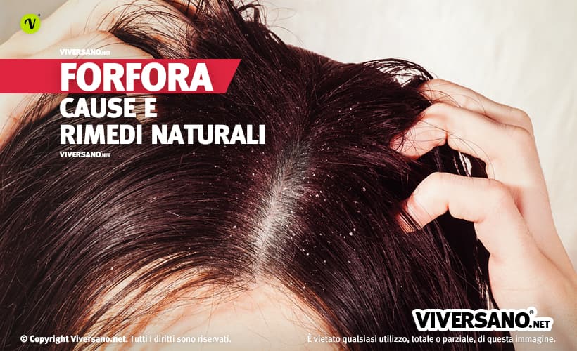 Donna con forfora sui capelli