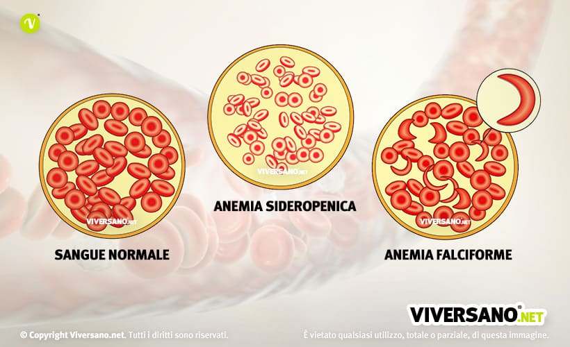 Immagine che rappresenta la condizione anemica e la concentrazione di globuli rossi nel sangue
