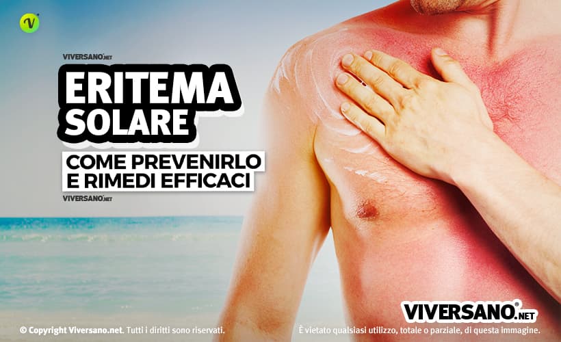 Come risolvere un eritema solare con rimedi naturali